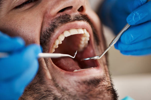 Best Emergency Wisdom Tooth Extraction in La Vergne, TN